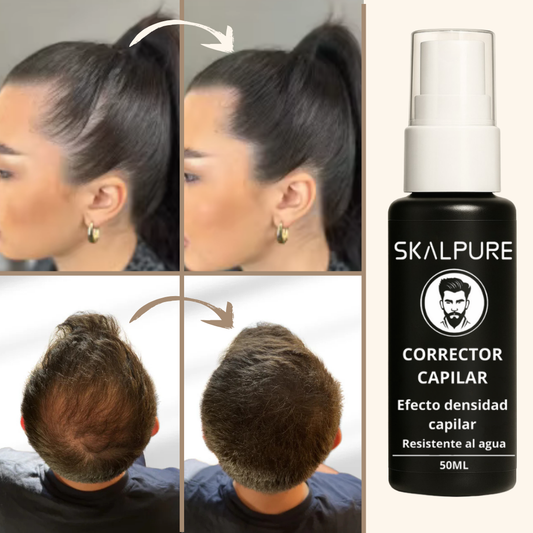 Antes y después Skalpure en hombre y mujer con calvicie